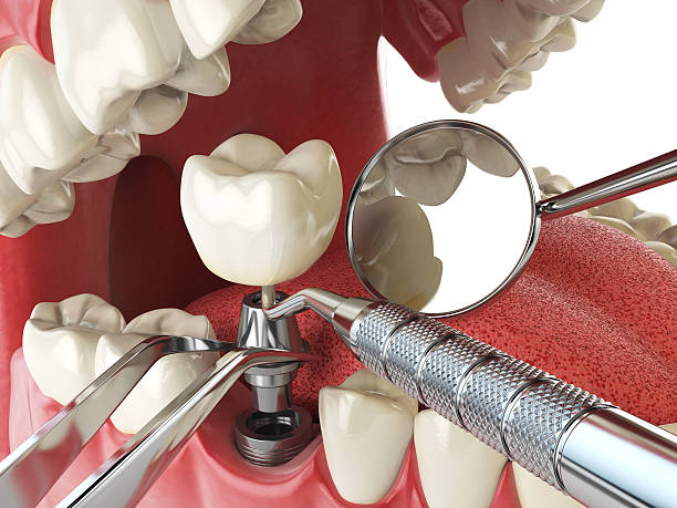 Best Lost Filling or Crown Replacement in Horizon West, FL